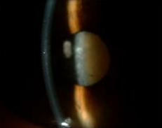Grauer Star Cataract Katarakt grüner Star Makuladegeneration AMD trockenes Auge Sicca Syndrom Office Eye Syndrom Augenarzt St Valentin